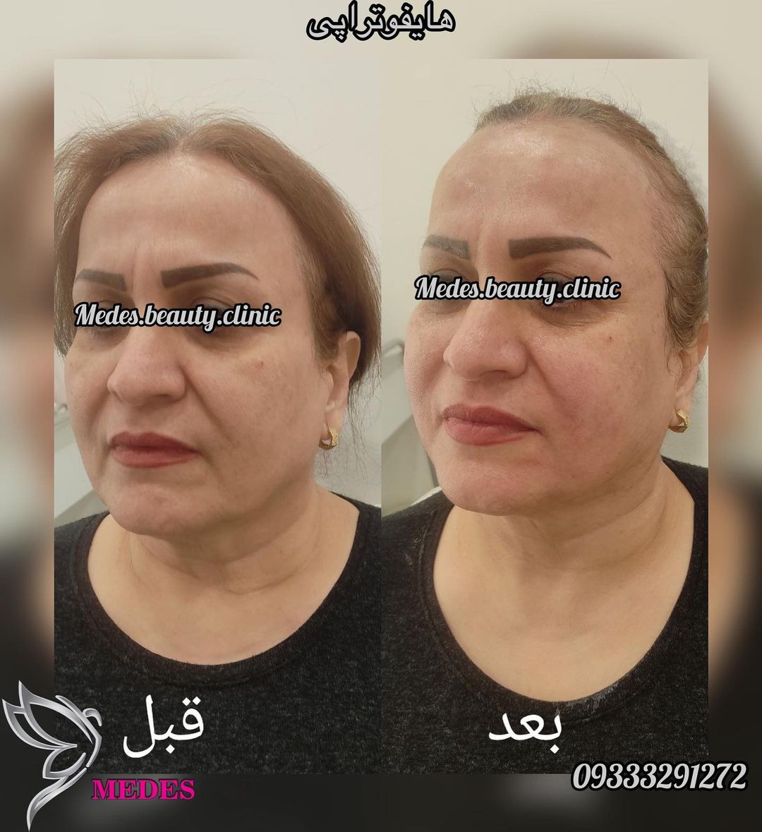 گالری هایفوتراپی